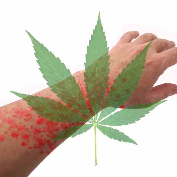 will-cbd-oil-help-with-hives-the-role-of-cannabidiol-in-reducing